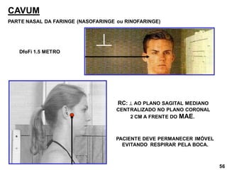 56
CAVUM
PARTE NASAL DA FARINGE (NASOFARINGE ou RINOFARINGE)
RC:  AO PLANO SAGITAL MEDIANO
CENTRALIZADO NO PLANO CORONAL
2 CM A FRENTE DO MAE.
DfoFi 1.5 METRO
PACIENTE DEVE PERMANECER IMÓVEL
EVITANDO RESPIRAR PELA BOCA.
 