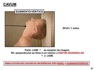 57
CAVUM
SUBMENTOVÉRTICE
Parte: LIOM ┴ ao receptor de imagem.
RC: perpendicular ao filme 4 cm inferior a SÍNFISE MANDIBULAR
┴ à LIOM.
DFoFi: 1 metro
PARA ESTUDODO CAVUM AS INCIDÊNCIAS SÃO PERFIL e SUBMENTOVÉRTICE
 