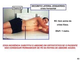 RC: 5cm acima da
crista ilíaca.
DECÚBITO LATERAL (ESQUERDO)
c/raio horizontal
DfoFi 1 metro.
ESSA INCIDÊNCIA SUBSTITUI O ABDOME EM ORTOSTÁTICO SE O PACIENTE
NÃO CONSEGUIR PERMANECER DE PÉ NA ROTINA DE ABDOME AGUDO.
63
Especial
 