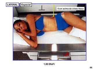 LATERAL
1.00 DfoFi
5 cm acima da crista ilíaca
66
Especial
 