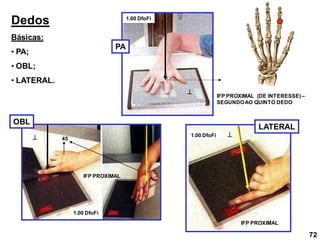 Dedos
Básicas:
• PA;
• OBL;
• LATERAL.
PA
OBL
LATERAL



IFP PROXIMAL (DE INTERESSE) –
SEGUNDOAO QUINTO DEDO
45
IFP PROXIMAL
IFP PROXIMAL
1.00 DfoFi
1.00 DfoFi
1.00 DfoFi
72
 