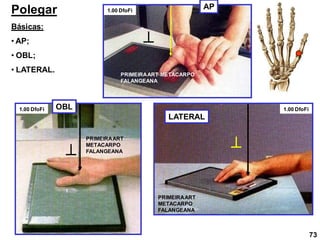 Polegar
Básicas:
• AP;
• OBL;
• LATERAL.
AP
LATERAL
OBL



PRIMEIRAART
METACARPO
FALANGEANA
PRIMEIRAART
METACARPO
FALANGEANA
PRIMEIRAART METACARPO
FALANGEANA
1.00 DfoFi
1.00 DfoFi
1.00 DfoFi
73
 