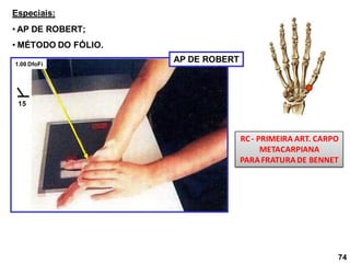 Especiais:
• AP DE ROBERT;
• MÉTODO DO FÓLIO.
AP DE ROBERT
1.00 DfoFi
15
RC- PRIMEIRA ART. CARPO
METACARPIANA
PARAFRATURADE BENNET
74
 