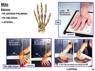 Mão
Básicas:
• PA (DORSO-PALMAR);
• PA OBLÍQUA;
• LATERAL.
PA OBLÍQUA
LATERAL
PA

3º ART
METACARPO
FALANGEANA

3º ART
METACARPO
FALANGEANA
3º ART
METACARPO
FALANGEANA
45 45
1.00 DfoFi
1.00 DfoFi
1.00 DfoFi
 

2º ART METACARPO FALANGEANA
76
 