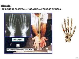 Especiais:
• AP OBLÍQUA BILATERAL – NOGAART ou PEGADOR DE BOLA.

5º s ART METACARPO FALANGEANAS
1.00 DfoFi
77
45
 