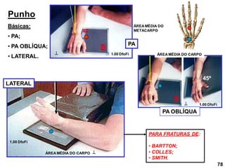 Punho
Básicas:
• PA;
• PA OBLÍQUA;
• LATERAL.
PA
LATERAL
PA OBLÍQUA



ÁREA MÉDIA DO
METACARPO
ÁREA MÉDIA DO CARPO
ÁREA MÉDIA DO CARPO
PARA FRATURAS DE:
• BARTTON;
• COLLES;
• SMITH.
1.00 DfoFi
1.00 DfoFi
1.00 DfoFi
78
45º
 