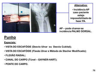 Alternativa:
• Incidência AP
caso paciente
esteja
impossibilitado de
fazer PA.
Punho
Especiais:
• VISTA DO ESCAFÓIDE (Desvio Ulnar ou Desvio Cubital);
• VISTA DO ESCAFÓIDE (Flexão Ulnar e Método de Stecher Modificado);
• FLEXÃO RADIAL;
• CANAL DO CARPO (Túnel – GAYNER-HART);
• PONTE DO CARPO.

AP – pode chamar-se
incidência PALMO DORSAL.
79
 