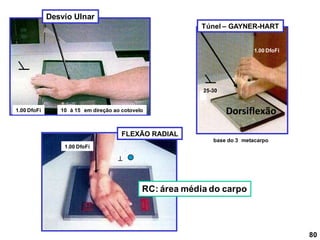 FLEXÃO RADIAL
10 à 15 em direção ao cotovelo
1.00 DfoFi


1.00 DfoFi
25-30
base do 3 metacarpo
Dorsiflexão
1.00 DfoFi
RC: área média do carpo
80
Desvio Ulnar
Túnel – GAYNER-HART
 