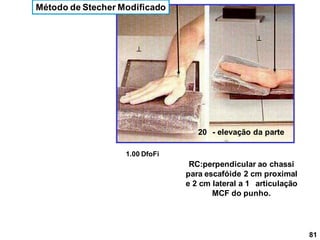 20 - elevação da parte
Método de Stecher Modificado


1.00 DfoFi
RC:perpendicular ao chassi
para escafóide 2 cm proximal
e 2 cm lateral a 1 articulação
MCF do punho.
81
 
