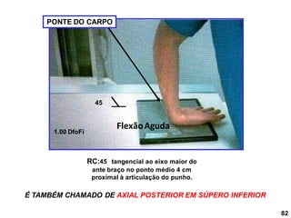 FlexãoAguda
RC:45 tangencial ao eixo maior do
ante braço no ponto médio 4 cm
proximal à articulação do punho.
1.00 DfoFi
45
82
É TAMBÉM CHAMADO DE AXIAL POSTERIOR EM SÚPERO INFERIOR
PONTE DO CARPO
 