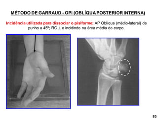 MÉTODO DE GARRAUD - OPI (OBLÍQUAPOSTERIOR INTERNA)
Incidência utilizada para dissociar o pisiforme; AP Oblíqua (médio-lateral) de
punho a 45º; RC  e incidindo na área média do carpo.
83
 
