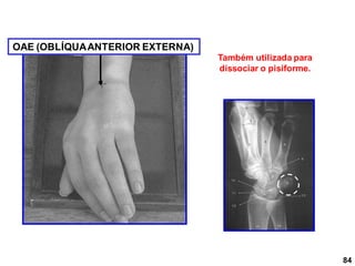 84
Também utilizada para
dissociar o pisiforme.
OAE (OBLÍQUAANTERIOR EXTERNA)
 
