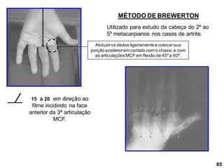 85
MÉTODO DE BREWERTON
15 à 20 em direção ao
filme incidindo na face
anterior da 3ª articulação
MCF.
Utilizado para estudo da cabeça do 2º ao
5º metacarpianos nos casos de artrite.
Abduziros dedos ligeiramentee colocarsua
porção posteriorem contato com o chassi,e com
as articulaçõesMCF em flexão de 45º a 60º.
 
