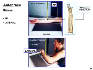 Antebraço
Básicas:
• AP;
• LATERAL.
AP
LATERAL
AP dissocia
RADIO e ULNA
 AO PONTO MÉDIO
1.00 DfoFi
DfoFi 1.00
86
 AO PONTO MÉDIO
 