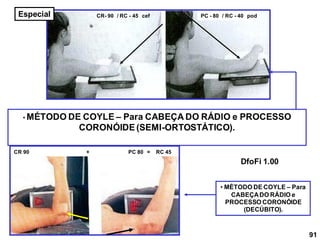 • MÉTODO DE COYLE – Para CABEÇA DO RÁDIO e PROCESSO
CORONÓIDE(SEMI-ORTOSTÁTICO).
• MÉTODO DE COYLE – Para
CABEÇADO RÁDIO e
PROCESSO CORONÓIDE
(DECÚBITO).
PC - 80 / RC - 40 pod
CR- 90 / RC - 45 cef
CR 90 + PC 80 = RC 45
91
DfoFi 1.00
Especial
 