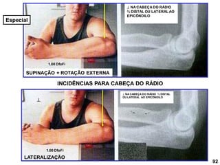 INCIDÊNCIAS PARA CABEÇA DO RÁDIO
 NA CABEÇA DO RÁDIO
⅔ DISTAL OU LATERALAO
EPICÔNDILO

SUPINAÇÃO + ROTAÇÃO EXTERNA
LATERALIZAÇÃO
1.00 DfoFi
1.00 DfoFi
92
Especial
 NA CABEÇA DO RÁDIO ⅔ DISTAL
OU LATERAL AO EPICÔNDILO
 