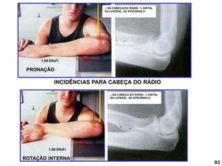 INCIDÊNCIAS PARA CABEÇA DO RÁDIO


PRONAÇÃO
ROTAÇÃO INTERNA
1.00 DfoFi
1.00 DfoFi
93
 NA CABEÇA DO RÁDIO ⅔ DISTAL
OU LATERAL AO EPICÔNDILO
 NA CABEÇA DO RÁDIO ⅔ DISTAL
OU LATERAL AO EPICÔNDILO
 