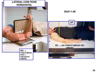 LATERAL COM FEIXE
HORIZONTAL
AP
RC: 
PONTO MÉDIO
DOS ⅔
DISTAIS DO
ÚMERO
RC:  AO PONTO MÉDIO DO
ÚMERO
95
DfoFi 1.00
 