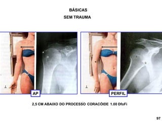 AP
2,5 CM ABAIXO DO PROCESSO CORACÓIDE 1.00 DfoFi
 
PERFIL
BÁSICAS
97
SEM TRAUMA
 