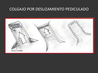 COLGAJO POR DESLIZAMIENTO PEDICULADO 