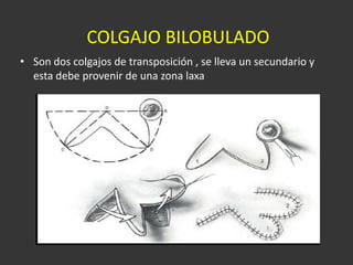 COLGAJO BILOBULADO  Son dos colgajos de transposición , se lleva un secundario y esta debe provenir de una zona laxa  