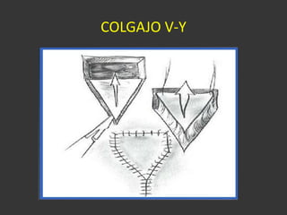 COLGAJO V-Y 