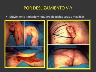 POR DESLIZAMIENTO V-Y Movimiento limitado y requiere de pieles laxas y movibles 