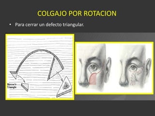 COLGAJO POR ROTACION Para cerrar un defecto triangular. 