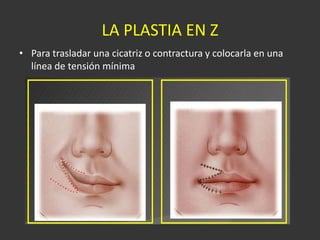 LA PLASTIA EN Z  Para trasladar una cicatriz o contractura y colocarla en una línea de tensión mínima  
