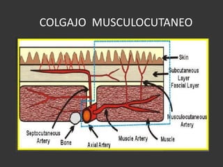 COLGAJO  MUSCULOCUTANEO  