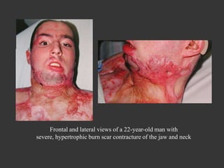 Frontal and lateral views of a 22-year-old man with severe, hypertrophic burn scar contracture of the jaw and neck 