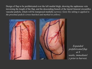 Design of flap  to be prefabricated over the left medial thigh, showing the saphenous vein traversing the length of the flap, and the descending branch of the lateral femoral circumflex vascular pedicle, which will be transposed medially ( arrow); Gore-Tex tubing is applied to the proximal pedicle (cross-hatched and marked in yellow). Expanded prefabricated flap at 8 weeks, immediately prior to harvest. 