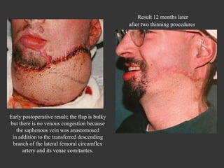 Early postoperative result; the flap is bulky but there is no venous congestion because the saphenous vein was anastomosed in addition to the transferred descending branch of the lateral femoral circumflex artery and its venae comitantes. Result 12 months later after two thinning procedures . 