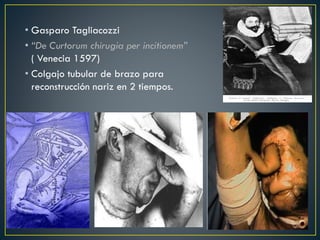 • Gasparo Tagliacozzi
• “De Curtorum chirugia per incitionem”
( Venecia 1597)
• Colgajo tubular de brazo para
reconstrucción nariz en 2 tiempos.
 