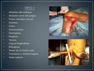 TIPO I
• Abductor del meñique.
• Abductor corto del pulgar.
• Primer interóseo dorsal.
• Ancóneo.
• Colon.
• Gastrocnemio.
• Geniogloso.
• Hiogloso.
• Yeyuno.
• Lingual longitudinal.
• Estilogloso.
• Tensor de la Fascia Lata.
• Transverso y vertical Lingual.
• Vasto Lateral.
 