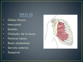 TIPO III
• Glúteo Mayor.
• Intercostal.
• Epiplón.
• Orbicular de la boca.
• Pectoral menor.
• Recto abdominal.
• Serrato anterior.
• Temporal.
 