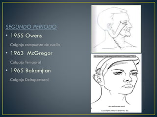 SEGUNDO PERIODO
• 1955 Owens
Colgajo compuesto de cuello
• 1963 McGregor
Colgajo Temporal
• 1965 Bakamjian
Colgajo Deltopectoral
 
