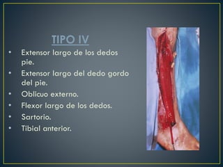 TIPO IV
• Extensor largo de los dedos
pie.
• Extensor largo del dedo gordo
del pie.
• Oblicuo externo.
• Flexor largo de los dedos.
• Sartorio.
• Tibial anterior.
 