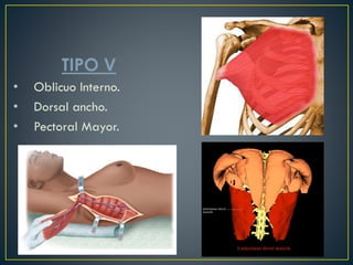TIPO V
• Oblicuo Interno.
• Dorsal ancho.
• Pectoral Mayor.
 