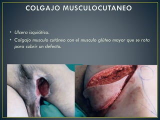 • Ulcera isquiática.
• Colgajo musculo cutáneo con el musculo glúteo mayor que se rota
para cubrir un defecto.
 