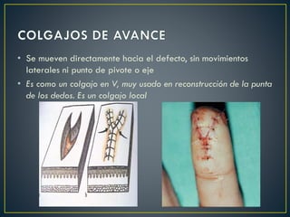 • Se mueven directamente hacia el defecto, sin movimientos
laterales ni punto de pivote o eje
• Es como un colgajo en V, muy usado en reconstrucción de la punta
de los dedos. Es un colgajo local
 
