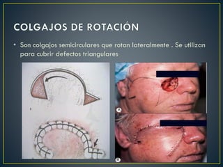 • Son colgajos semicirculares que rotan lateralmente . Se utilizan
para cubrir defectos triangulares
 