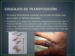 • Se mueve lateralmente saltando una porción de tejido sano
para cubrir un defecto adyacente
• Zetoplastia, es un colgajo muy usado para reconstrucciones de boca, ojos, o
cicatrices retractiles como quemaduras como suele ocurrir a nivel de manos,
cuello. Tiene ventana de trasponer colgajos para romper la dirección de la
cicatriz y además estirarla. Se consigue un mejor movimiento de la zona que
esta retraida.
 