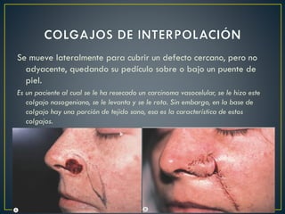 Se mueve lateralmente para cubrir un defecto cercano, pero no
adyacente, quedando su pedículo sobre o bajo un puente de
piel.
Es un paciente al cual se le ha resecado un carcinoma vasocelular, se le hizo este
colgajo nasogeniano, se le levanta y se le rota. Sin embargo, en la base de
colgajo hay una porción de tejido sano, esa es la característica de estos
colgajos.
 