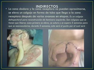 • La zona dadora y la zona receptora no pueden aproximarse,
se eleva un colgajo en forma de tubo que llega a la zona
receptora después de varios avances en etapas. Es un colgajo
deltopectoral para reconstrucción de hemicara izquierda. Son colgajos que se
tienen que liberar, osea primero se eleva, se sutura y se espera 3 semanas para
que se neovascularice, durante 3 semanas, este será el punto por el cual será
irrigado.
 