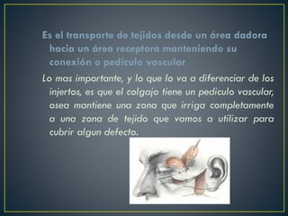 Es el transporte de tejidos desde un área dadora
hacia un área receptora manteniendo su
conexión o pedículo vascular
Lo mas importante, y lo que lo va a diferenciar de los
injertos, es que el colgajo tiene un pediculo vascular,
osea mantiene una zona que irriga completamente
a una zona de tejido que vamos a utilizar para
cubrir algun defecto.
 