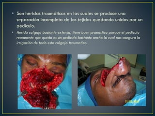 • Son heridas traumáticas en las cuales se produce una
separación incompleta de los tejidos quedando unidos por un
pedículo.
• Herida colgajo bastante extensa, tiene buen pronostico porque el pediculo
remanente que quedo es un pediculo bastante ancho lo cual nos asegura la
irrigación de todo este colgajo traumatico.
 
