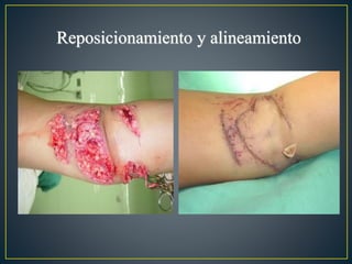 Reposicionamiento y alineamiento
 