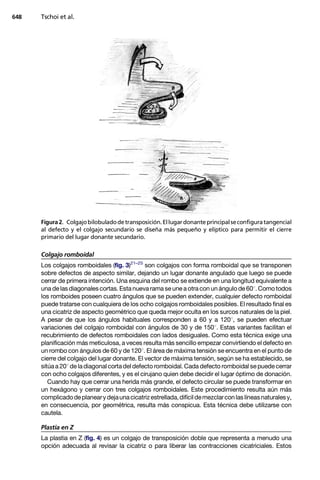 648   Tschoi et al.




      Figura 2. Colgajo bilobulado de transposición. El lugar donante principal se configura tangencial
      al defecto y el colgajo secundario se diseña más pequeño y elíptico para permitir el cierre
      primario del lugar donante secundario.

      Colgajo romboidal
      Los colgajos romboidales (fig. 3)21–25 son colgajos con forma romboidal que se transponen
      sobre defectos de aspecto similar, dejando un lugar donante angulado que luego se puede
      cerrar de primera intención. Una esquina del rombo se extiende en una longitud equivalente a
      una de las diagonales cortas. Esta nueva rama se une a otra con un ángulo de 601. Como todos
      los romboides poseen cuatro ángulos que se pueden extender, cualquier defecto romboidal
      puede tratarse con cualquiera de los ocho colgajos romboidales posibles. El resultado final es
      una cicatriz de aspecto geométrico que queda mejor oculta en los surcos naturales de la piel.
      A pesar de que los ángulos habituales corresponden a 60 y a 1201, se pueden efectuar
      variaciones del colgajo romboidal con ángulos de 30 y de 1501. Estas variantes facilitan el
      recubrimiento de defectos romboidales con lados desiguales. Como esta técnica exige una
      planificación más meticulosa, a veces resulta más sencillo empezar convirtiendo el defecto en
      un rombo con ángulos de 60 y de 1201. El área de máxima tensión se encuentra en el punto de
      cierre del colgajo del lugar donante. El vector de máxima tensión, según se ha establecido, se
      sitúa a 201 de la diagonal corta del defecto romboidal. Cada defecto romboidal se puede cerrar
      con ocho colgajos diferentes, y es el cirujano quien debe decidir el lugar óptimo de donación.
         Cuando hay que cerrar una herida más grande, el defecto circular se puede transformar en
      un hexágono y cerrar con tres colgajos romboidales. Este procedimiento resulta aún más
      complicado de planear y deja una cicatriz estrellada, difícil de mezclar con las líneas naturales y,
      en consecuencia, por geométrica, resulta más conspicua. Esta técnica debe utilizarse con
      cautela.

      Plastia en Z
      La plastia en Z (fig. 4) es un colgajo de transposición doble que representa a menudo una
      opción adecuada al revisar la cicatriz o para liberar las contracciones cicatriciales. Estos
 