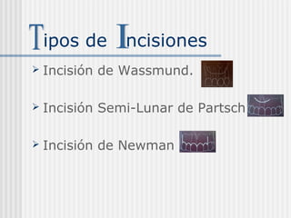 ipos de ncisiones
 Incisión de Wassmund.
 Incisión Semi-Lunar de Partsch
 Incisión de Newman
 